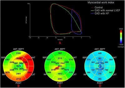 Myocardial Work by Speckle Tracking Echocardiography Accurately Assesses Left Ventricular Function of Coronary Artery Disease Patients